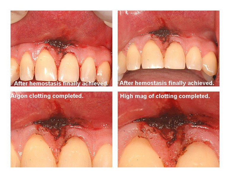 Frenectomy Pg 5 edited_resize.jpg